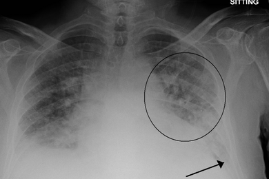 X-ray of a pulmonary edema