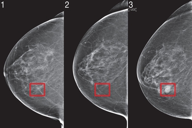 Three mammogram images, with a breast cancer lesion on the third slide