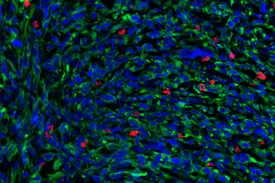 Microscope image of hundreds of tumor shows cells stained in blue, green, and red, on a black background