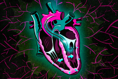 Drawing of a human heart shows a cable with a hook-shaped device inside the heart. Arrows showing movement of the heart.